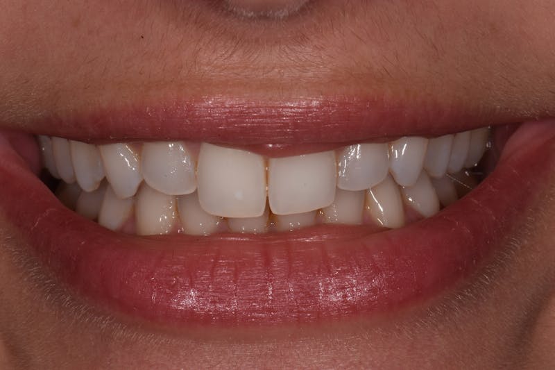 Patient Smile Before & After Gallery - Patient 619348 - Image 1