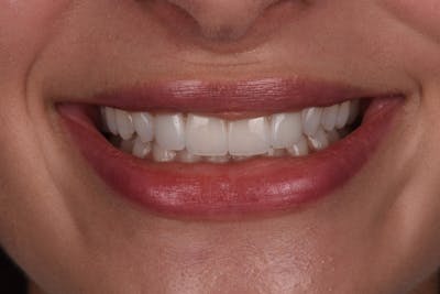 Patient Smile Before & After Gallery - Patient 619348 - Image 2