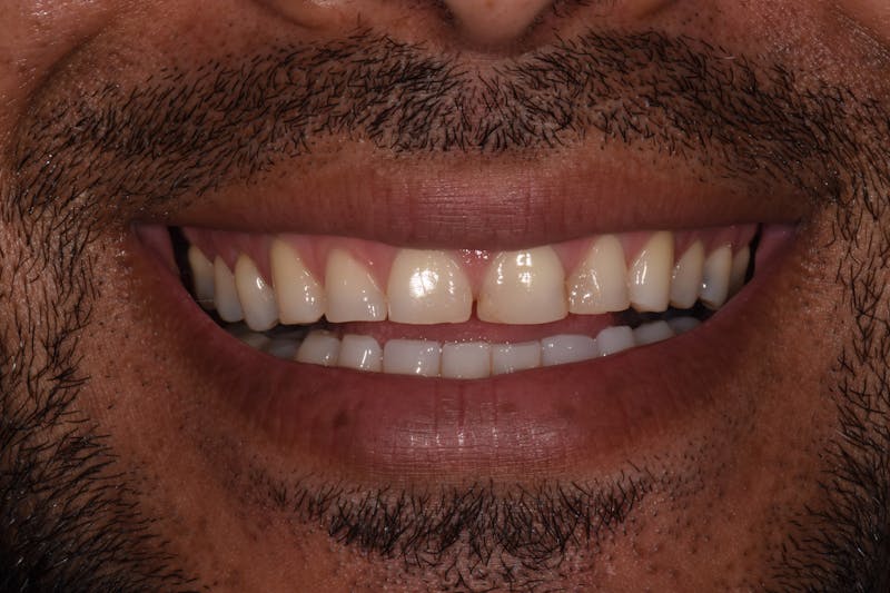 Patient Smile Before & After Gallery - Patient 195313 - Image 1