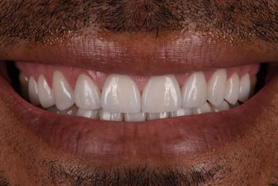 Patient Smile Before & After Gallery - Patient 195313 - Image 2