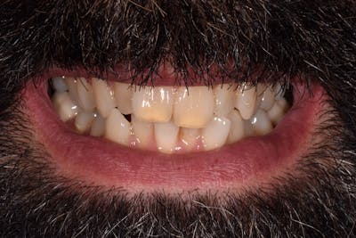 Patient Smile Before & After Gallery - Patient 193154 - Image 1