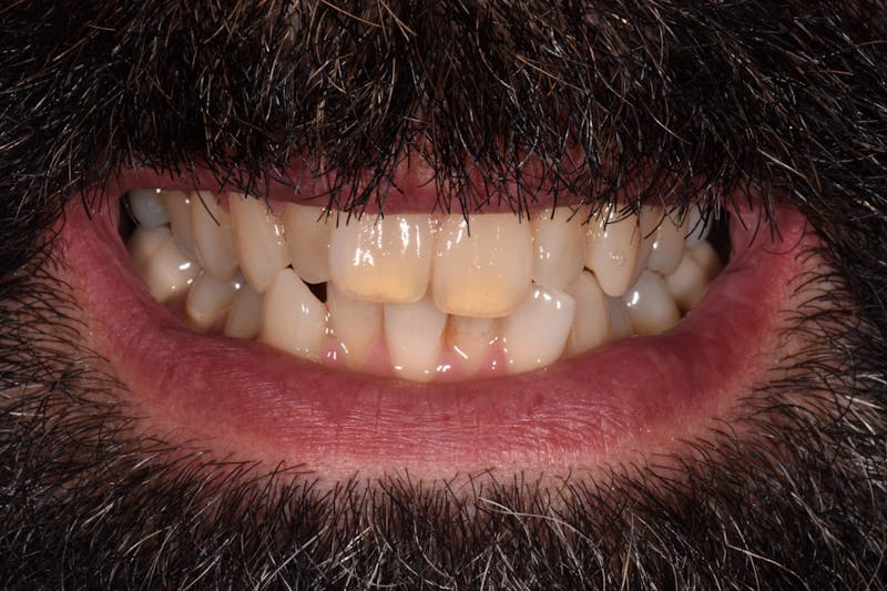 Patient Smile Before & After Gallery - Patient 193154 - Image 1