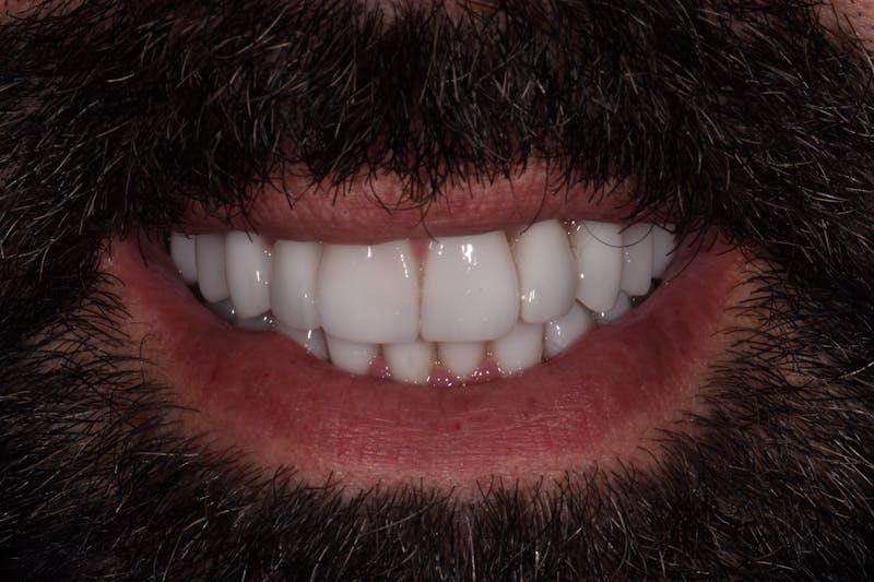 Patient Smile Before & After Gallery - Patient 193154 - Image 2