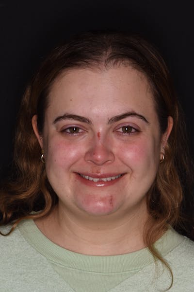 Patient Smile Before & After Gallery - Patient 235040 - Image 1