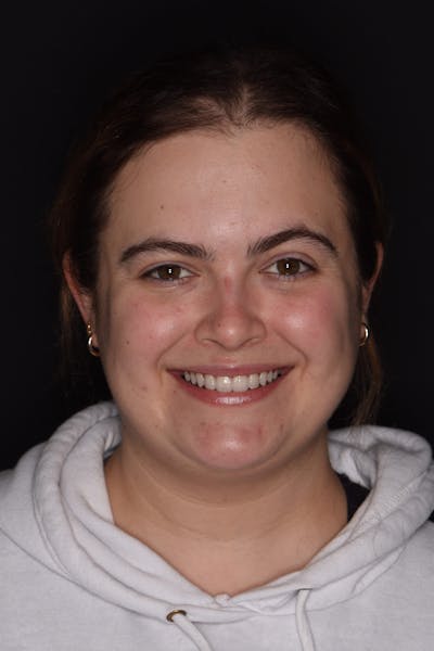 Patient Smile Before & After Gallery - Patient 235040 - Image 2