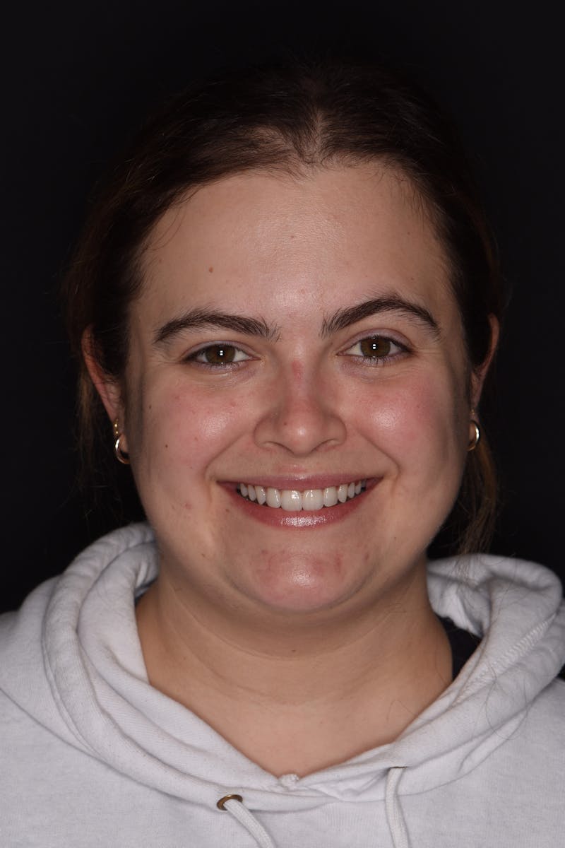 Patient Smile Before & After Gallery - Patient 235040 - Image 2