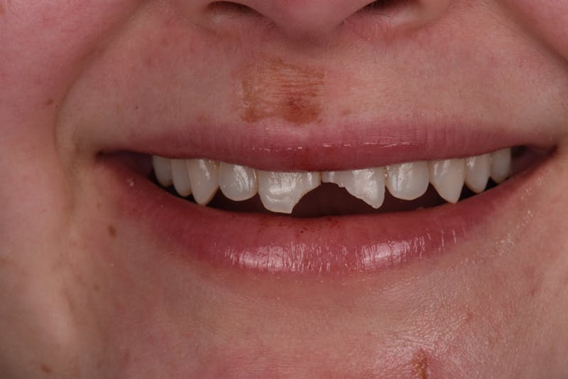 Patient Smile Before & After Gallery - Patient 235040 - Image 3