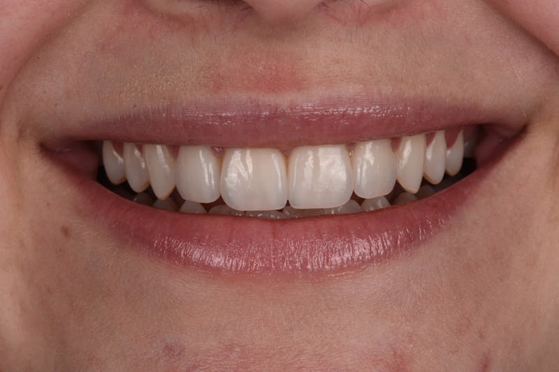 Patient Smile Before & After Gallery - Patient 235040 - Image 4