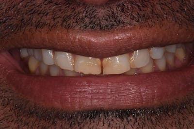 Patient Smile Before & After Gallery - Patient 370880 - Image 1