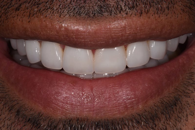 Patient Smile Before & After Gallery - Patient 370880 - Image 2
