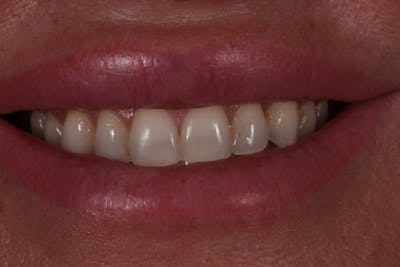 Patient Smile Before & After Gallery - Patient 420977 - Image 1