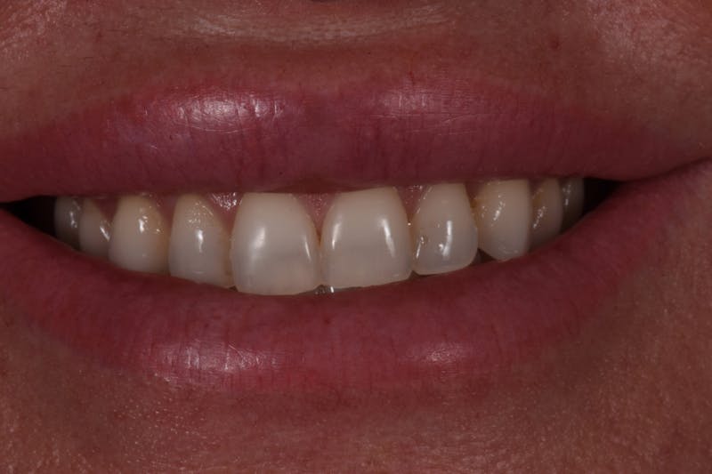 Patient Smile Before & After Gallery - Patient 420977 - Image 1