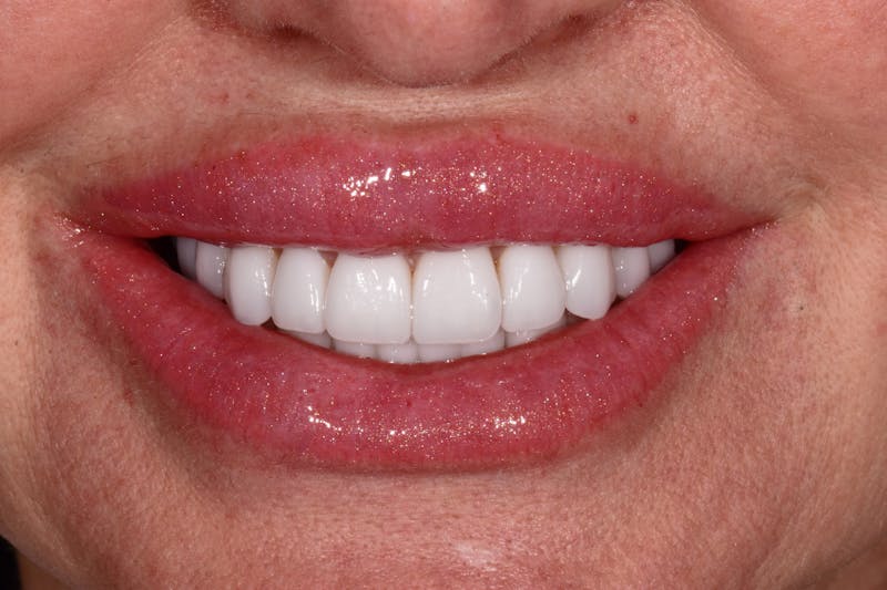 Patient Smile Before & After Gallery - Patient 420977 - Image 2