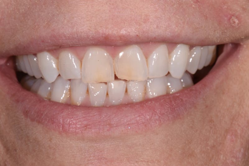 Patient Smile Before & After Gallery - Patient 381251 - Image 1