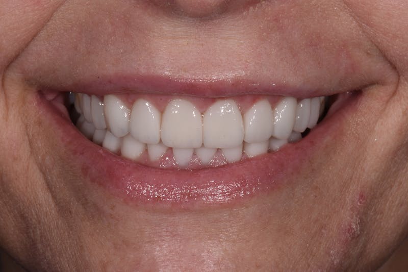 Patient Smile Before & After Gallery - Patient 381251 - Image 2