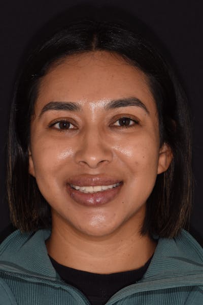 Patient Smile Before & After Gallery - Patient 311954 - Image 1