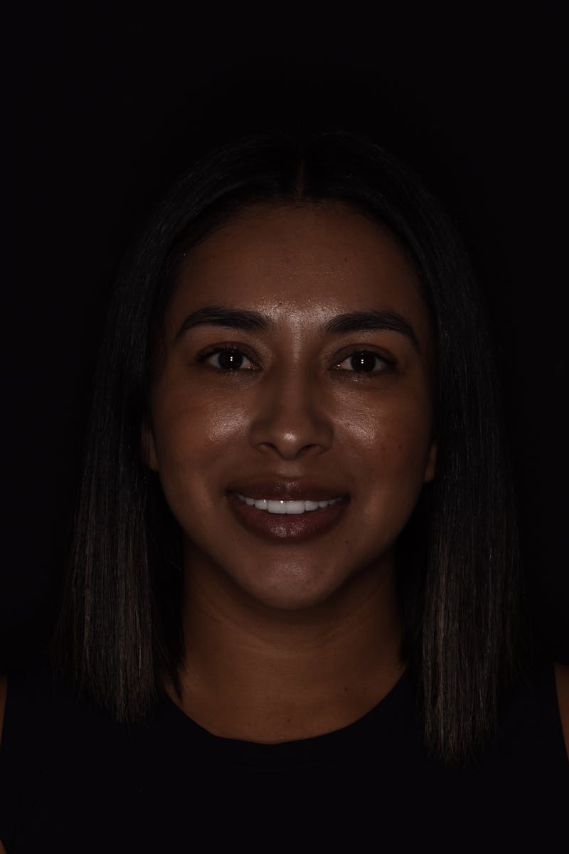 Patient Smile Before & After Gallery - Patient 311954 - Image 2