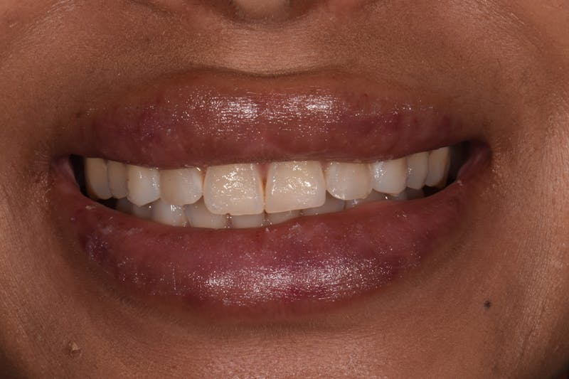 Patient Smile Before & After Gallery - Patient 311954 - Image 3