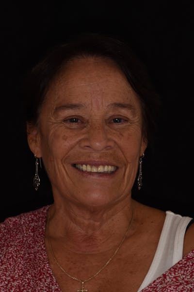 Patient Smile Before & After Gallery - Patient 333830 - Image 1