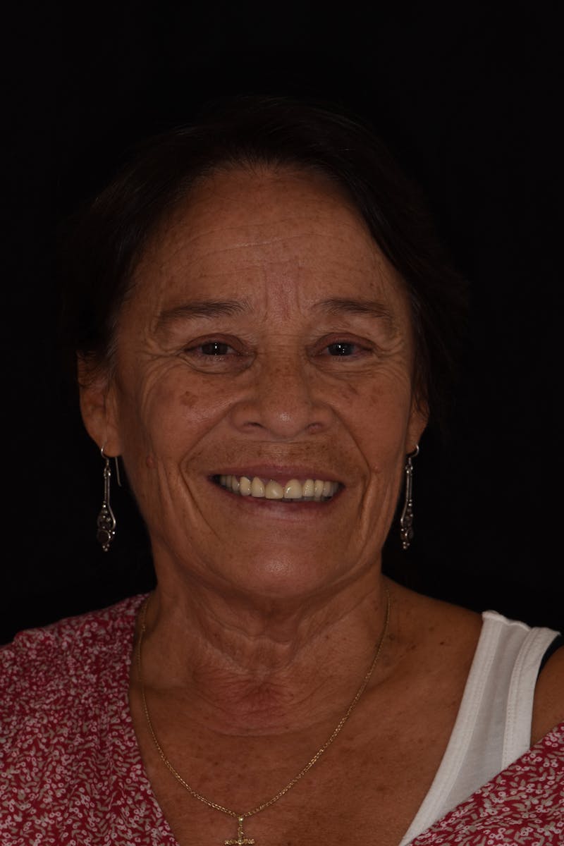 Patient Smile Before & After Gallery - Patient 333830 - Image 1