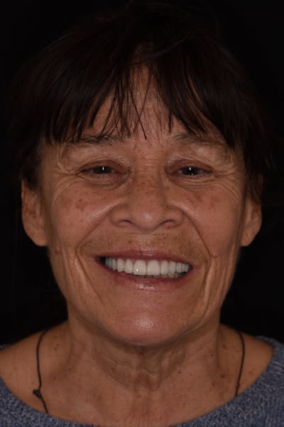 Patient Smile Before & After Gallery - Patient 333830 - Image 2