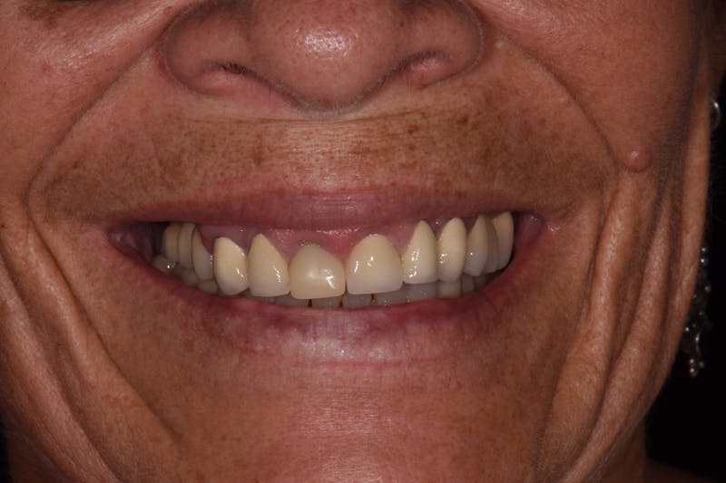 Patient Smile Before & After Gallery - Patient 333830 - Image 3