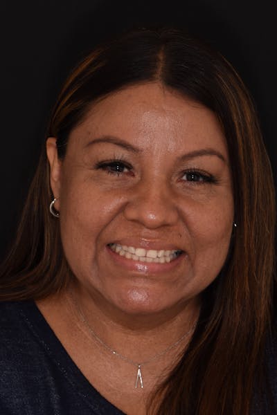 Patient Smile Before & After Gallery - Patient 144373 - Image 1