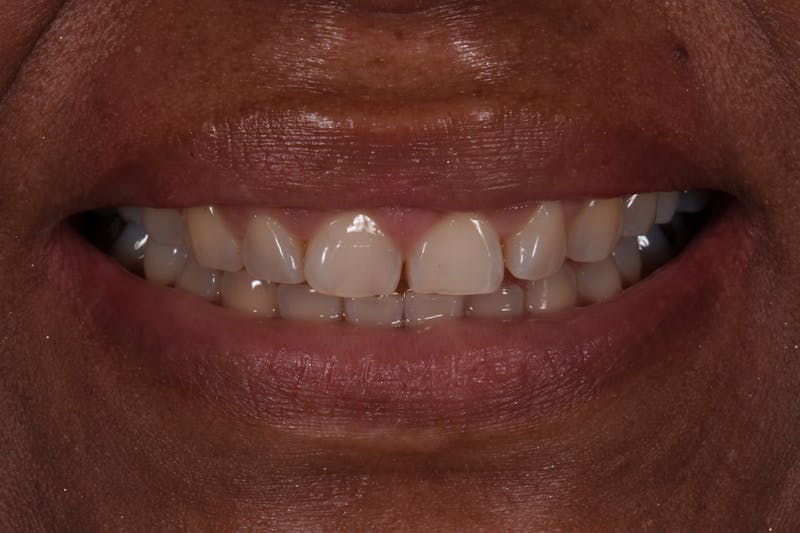 Patient Smile Before & After Gallery - Patient 144373 - Image 3