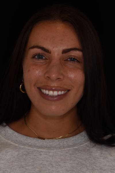 Patient Smile Before & After Gallery - Patient 380753 - Image 1