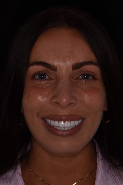 Patient Smile Before & After Gallery - Patient 380753 - Image 2