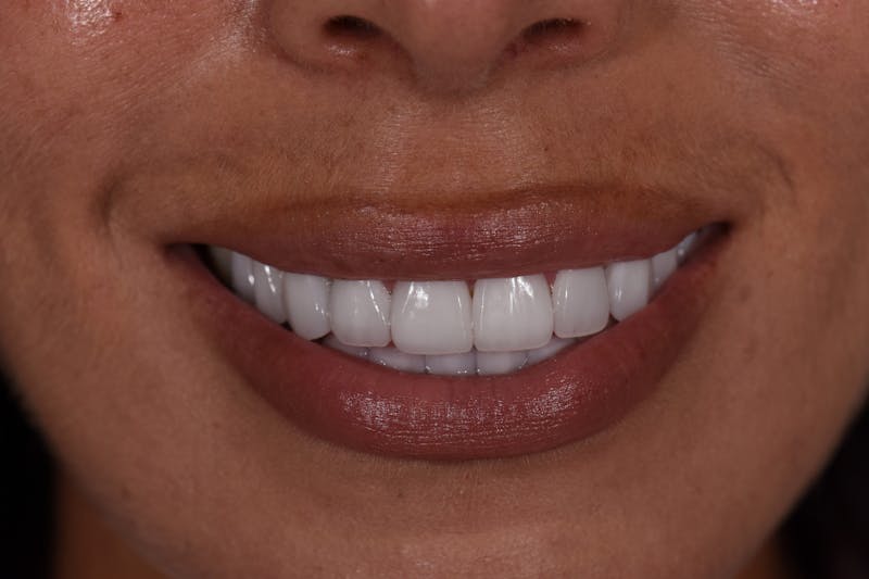 Patient Smile Before & After Gallery - Patient 380753 - Image 4