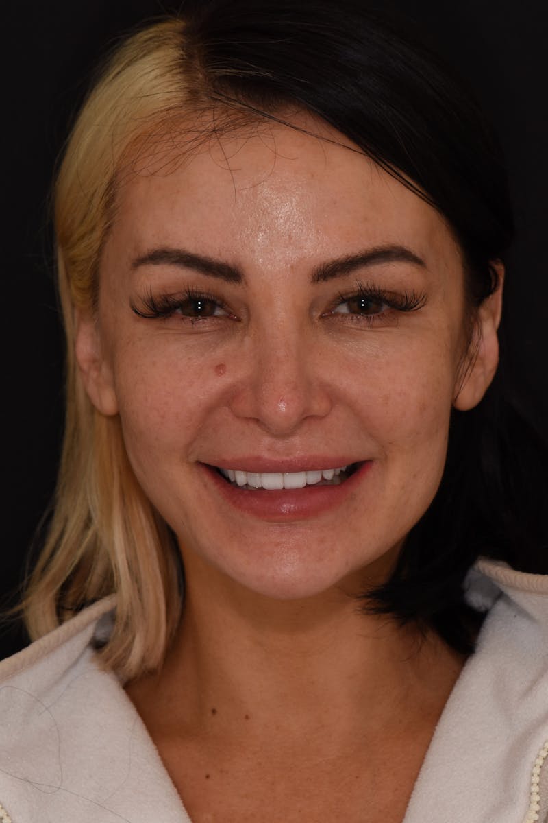 Patient Smile Before & After Gallery - Patient 189366 - Image 1