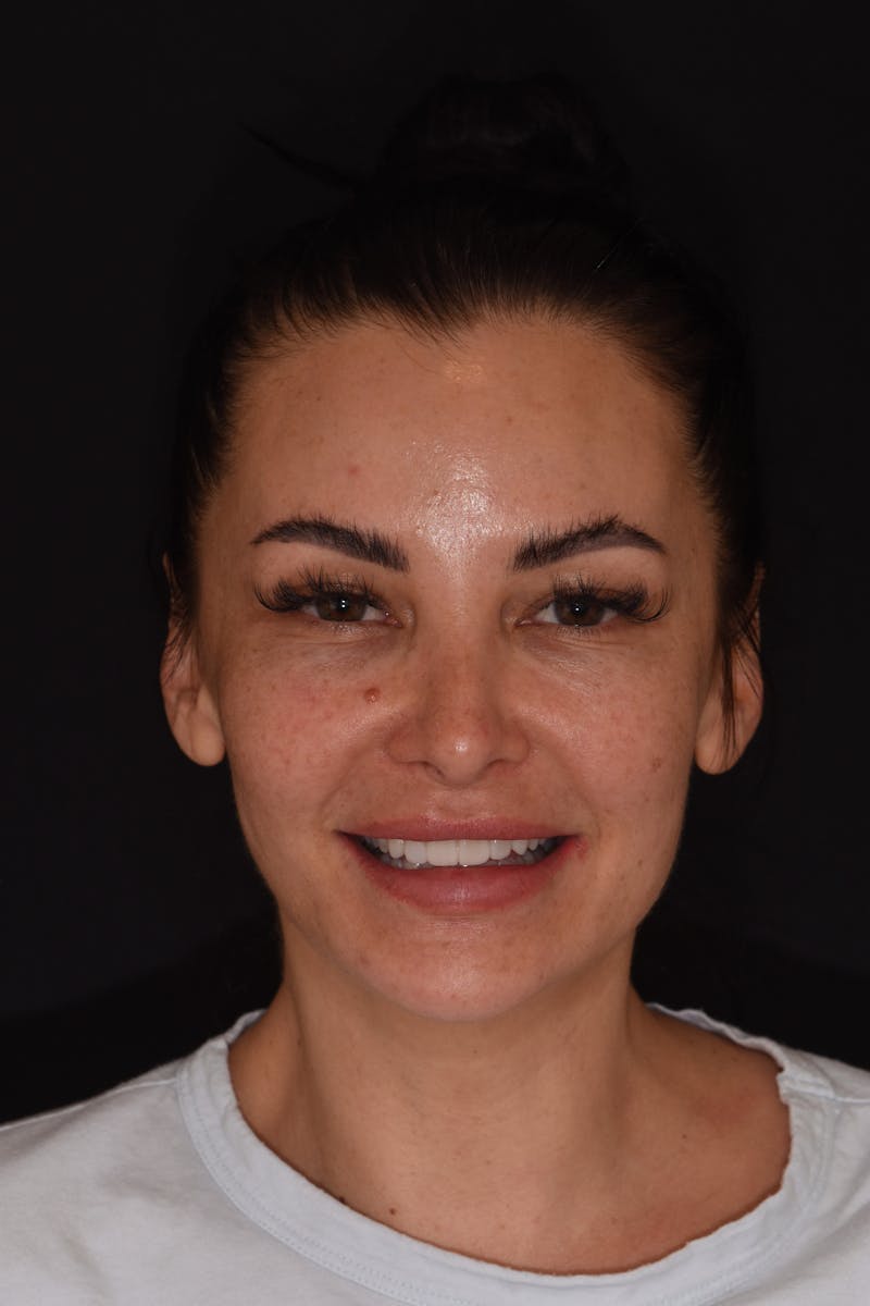 Patient Smile Before & After Gallery - Patient 189366 - Image 2