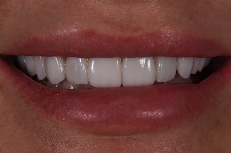 Patient Smile Before & After Gallery - Patient 189366 - Image 4