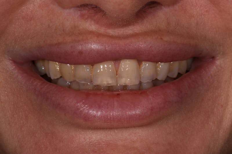 Patient Smile Before & After Gallery - Patient 199379 - Image 1