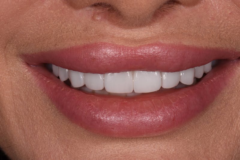 Patient Smile Before & After Gallery - Patient 199379 - Image 2