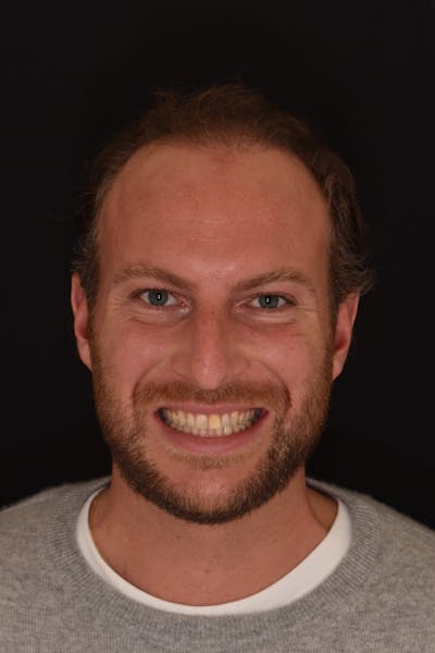 Patient Smile Before & After Gallery - Patient 375106 - Image 1