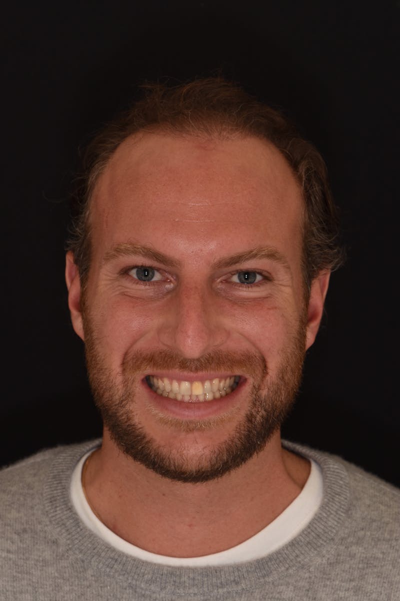 Patient Smile Before & After Gallery - Patient 375106 - Image 1