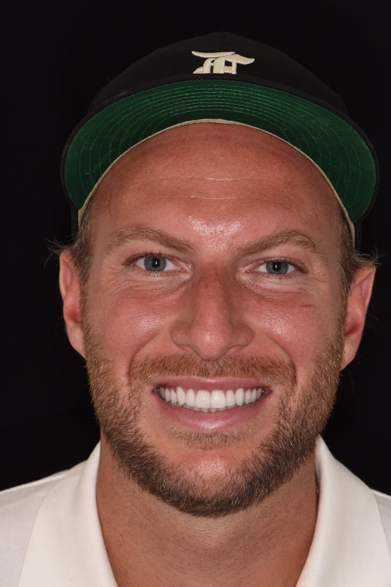 Patient Smile Before & After Gallery - Patient 375106 - Image 2