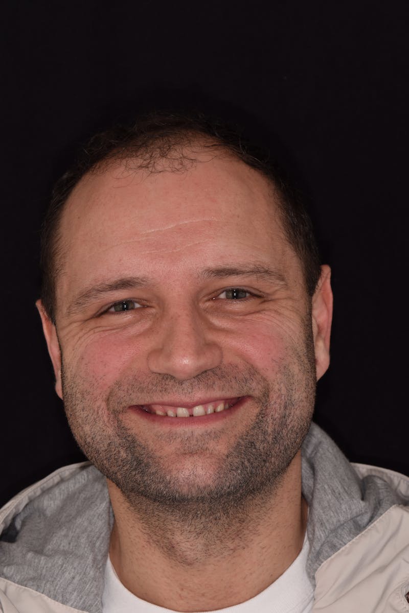 Patient Smile Before & After Gallery - Patient 374369 - Image 1