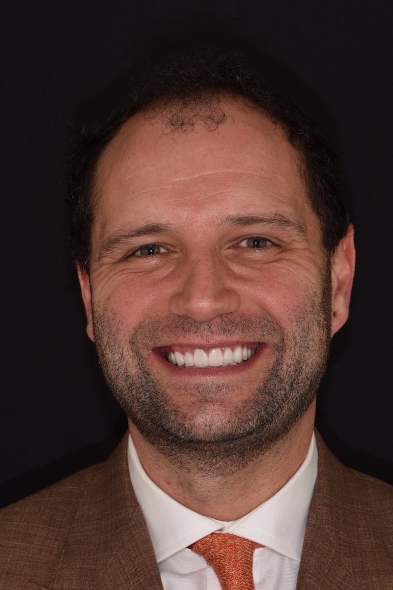 Patient Smile Before & After Gallery - Patient 374369 - Image 2