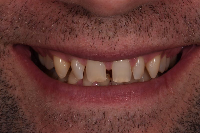 Patient Smile Before & After Gallery - Patient 374369 - Image 3