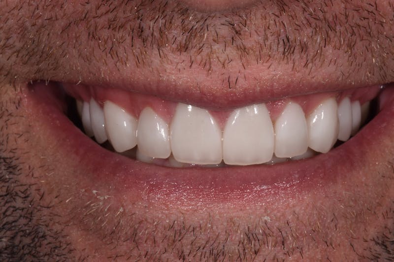 Patient Smile Before & After Gallery - Patient 374369 - Image 4