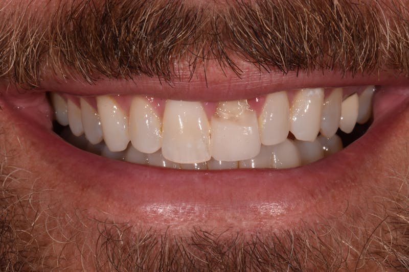 Patient Smile Before & After Gallery - Patient 901867 - Image 1