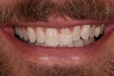 Patient Smile Before & After Gallery - Patient 901867 - Image 1