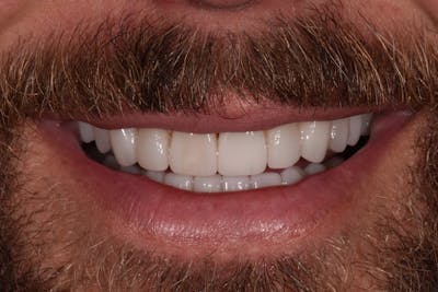 Patient Smile Before & After Gallery - Patient 901867 - Image 2