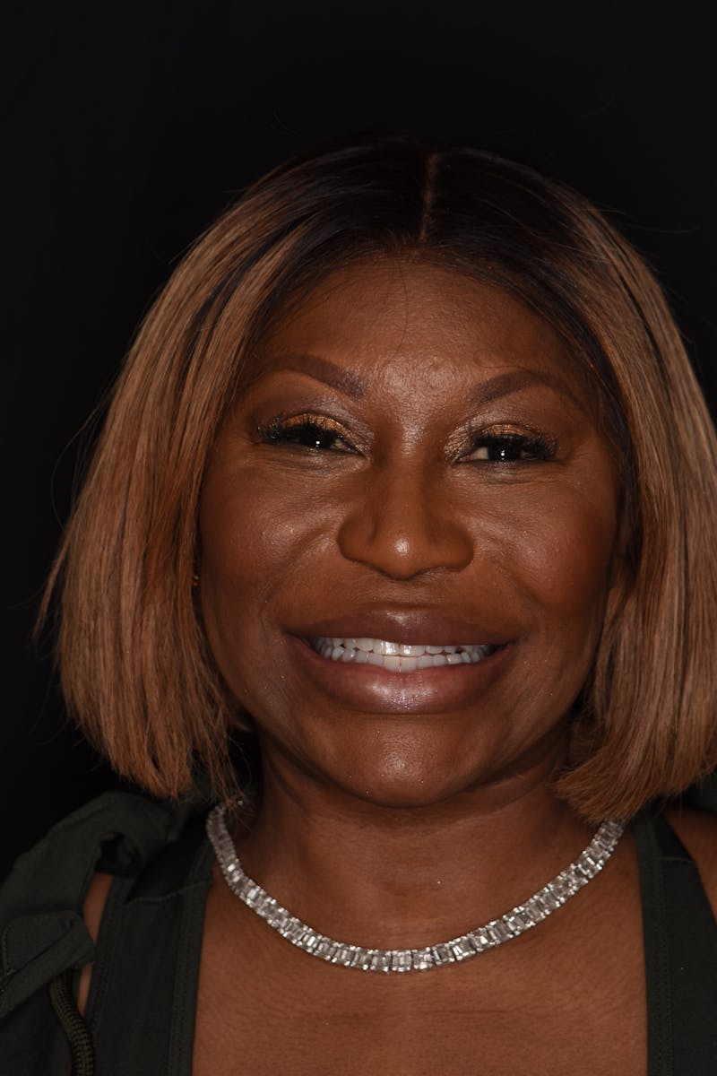 Patient Smile Before & After Gallery - Patient 330273 - Image 1