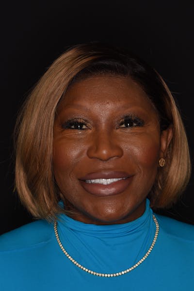 Patient Smile Before & After Gallery - Patient 330273 - Image 2