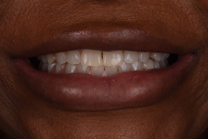 Patient Smile Before & After Gallery - Patient 330273 - Image 3