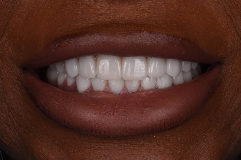 Patient Smile Before & After Gallery - Patient 330273 - Image 4